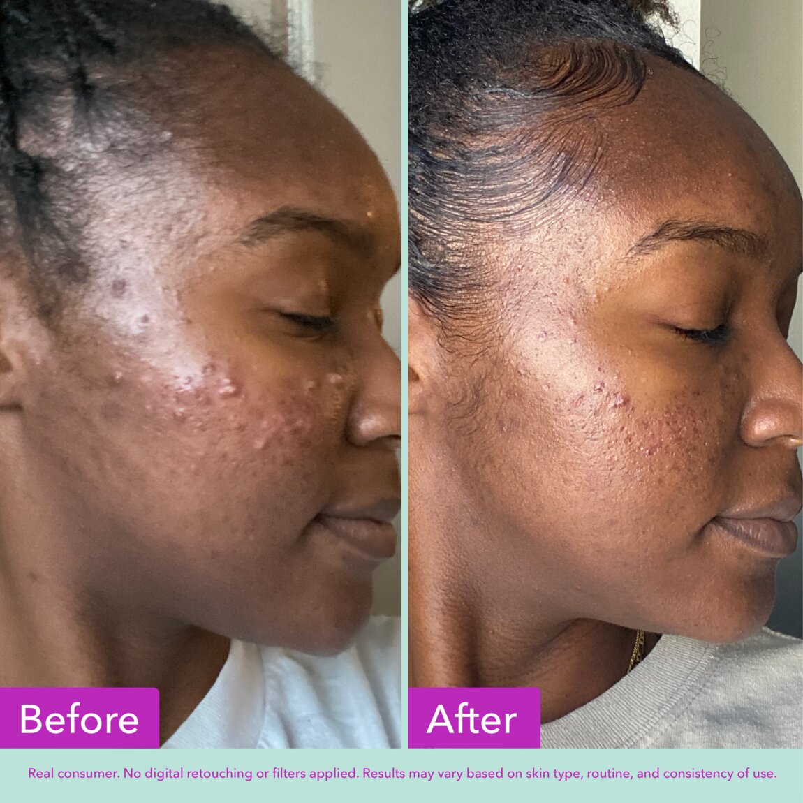 acne-foaming-cleanser-l7 zb_p.jpg